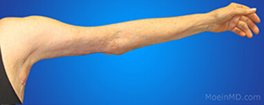 Arm liposuction recovery