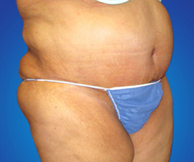 Full tummy tuck liposuction after