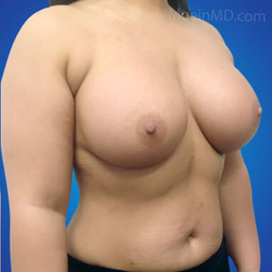 Breast Augmentation with silicone implants after image