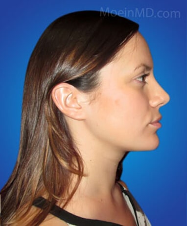 Rhinoplasty after