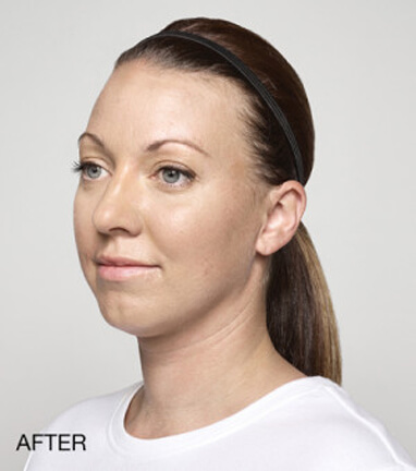 dermal filler results after