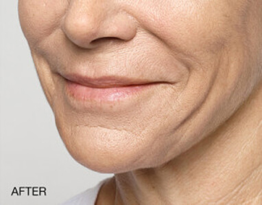 best dermal filler injector after
