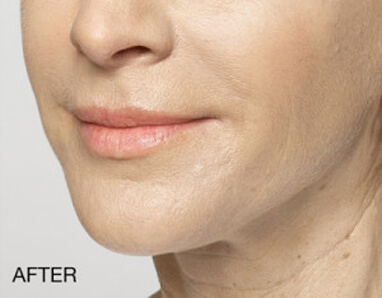 dermal filler lips swelling after