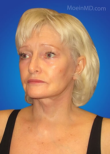 face lift after result
