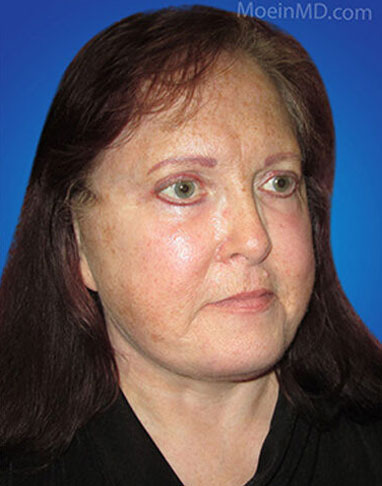 Full lower face and neck lift, upper and lower blepharoplasty with fat grafting and laser skin resurfacing after