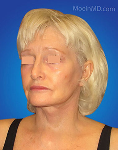 face and neck lift after image