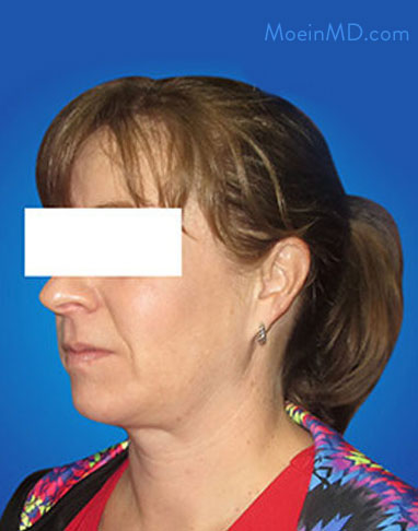neck lift surgery after