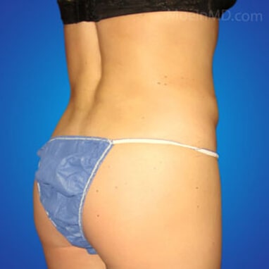 Liposuction butt after