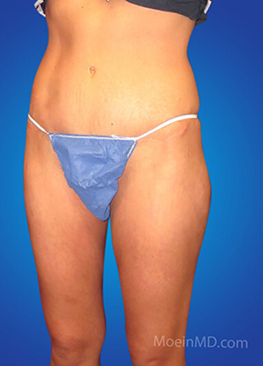 Liposuction of thighs after