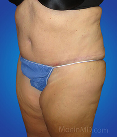 belly liposuction after