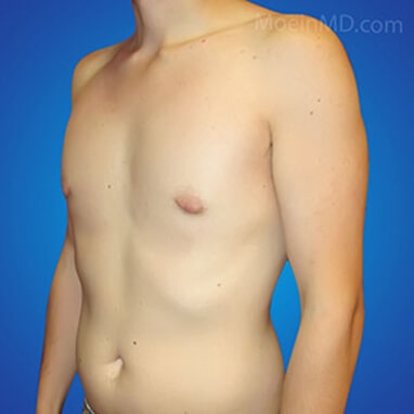 breast reduction for men after