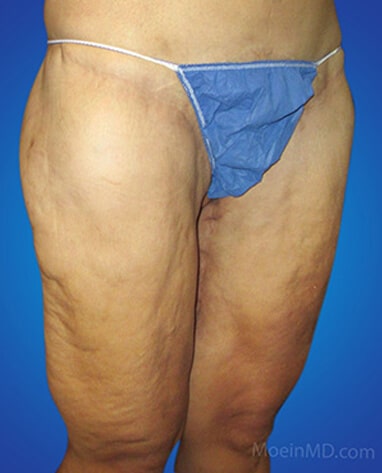 Thigh lift surgery after