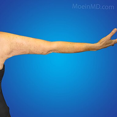 arm liposuction