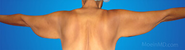 arm fat liposuction before
