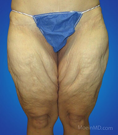 Medial thigh lift before