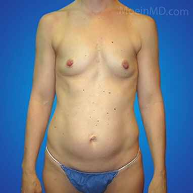 Tummy tuck before