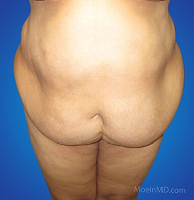 Full tummy tuck with associated liposuction to waist and abdomen before