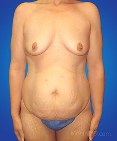 tummy tuck and breast lift before