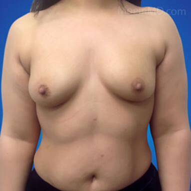 Breast Augmentation with silicone implants 575cc before