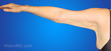 before picture of arm liposuction