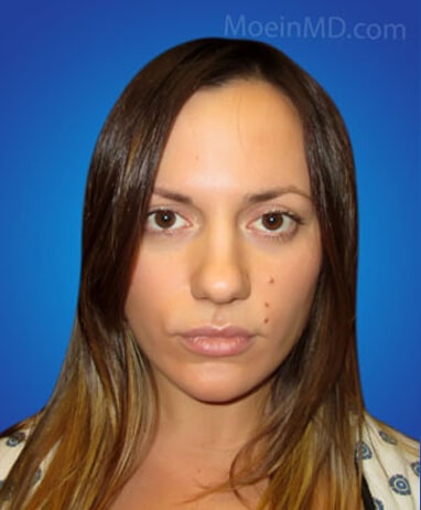 Rhinoplasty before image