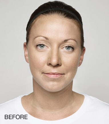 dermal filler injections before