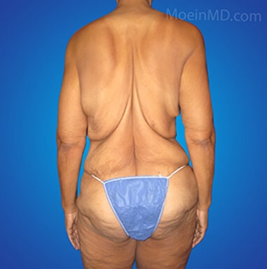 what is a body lift?