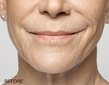 lip filler before