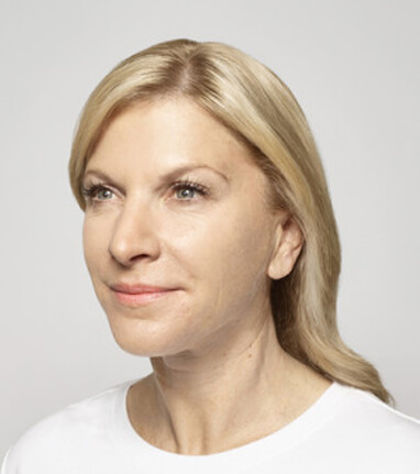 best dermal filler for vertical lip lines before
