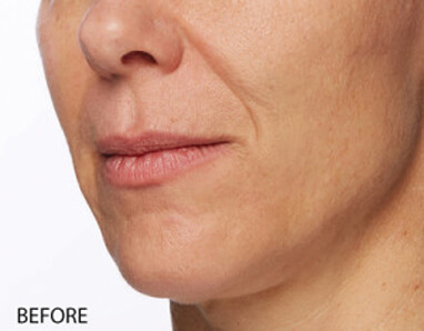 Dermal fillers before