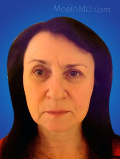 Total facial rejuvenation with deep cheek filler injection before