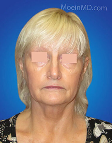 face and neck lift before