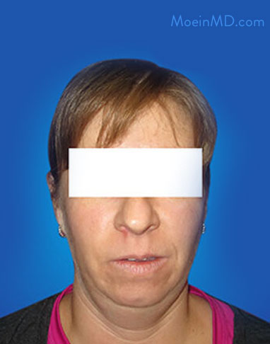 neck lift before
