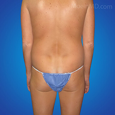 The Brazilian butt lift before