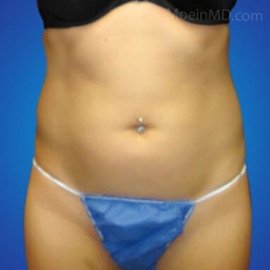 Liposuction abdominal before