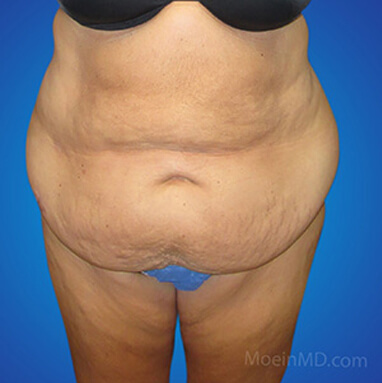 lipo lower abdomen before