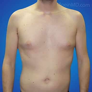 male breast reduction surgery before