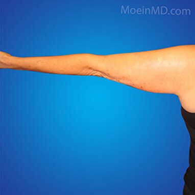 arm lipo