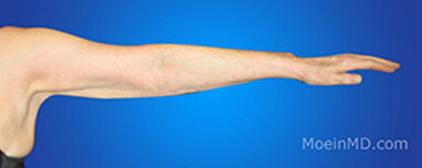 arm liposuction photo