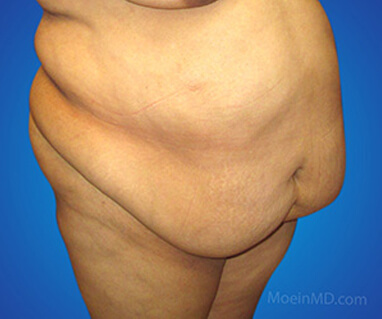 Full tummy tuck liposuction before
