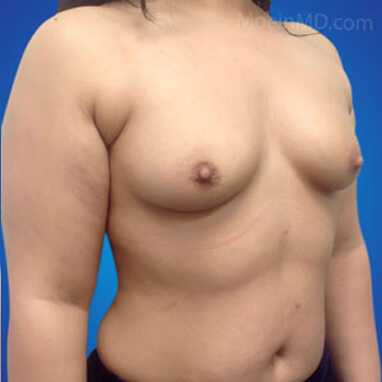 Breast Augmentation with silicone implants before image