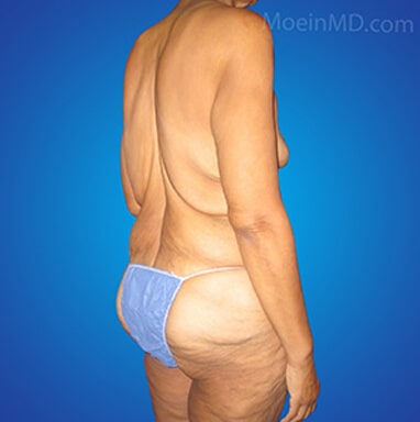 Body lift before
