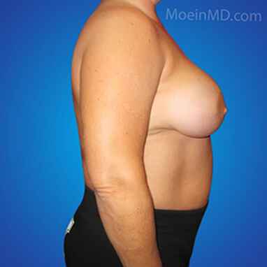 breast reduction procedure before