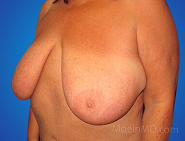 breast reduction before results