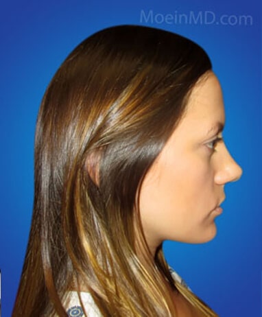Rhinoplasty before