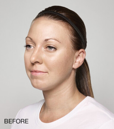 Dermal filler results before