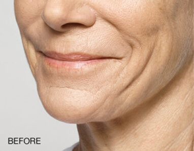 best dermal filler injector before