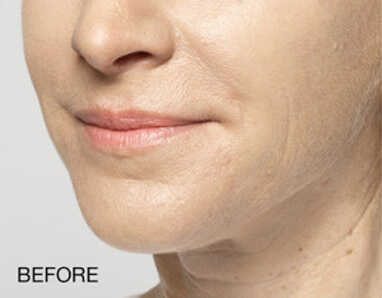 dermal filler lips swelling before