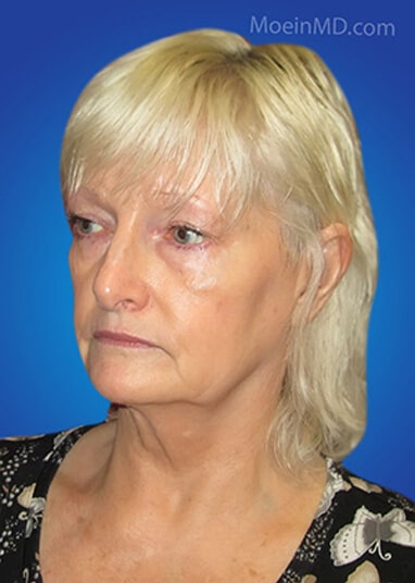 face lift before result