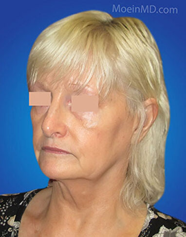 face and neck lift before image